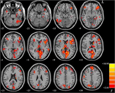 Altered Brain Functional Asymmetry in Patients With Major Depressive Disorder Related to Gastrointestinal Symptoms